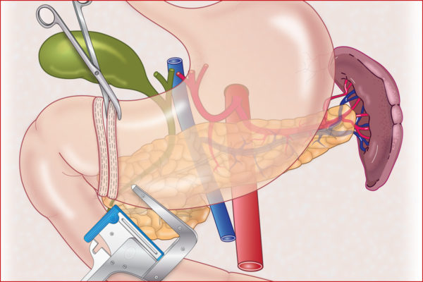 medical illustration of TA stapler used in surgery