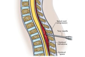 Spinal cord compression due to epidural hematoma