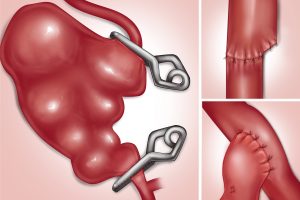 Aneurysm clips and artery anastomosis