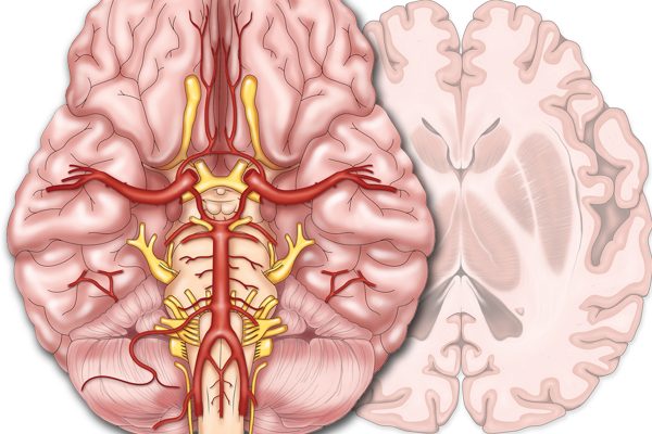 Media Solutions; Illustration; University of Wisconsin; School of Medicine and Public Health; UW-Madison; Medical Illustration, neurology, neuroradiology, brain, nervous system
