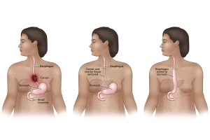 Patient education illustration of an esophagectomy procedure