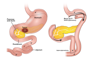 Illustrations of a gastric surgery procedure